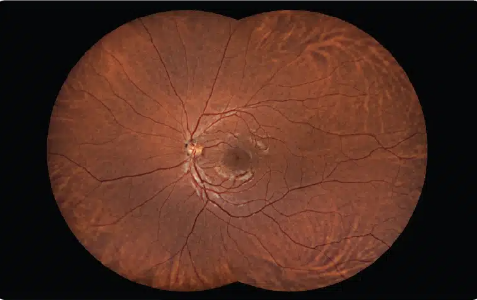Extended Digital Retinal Imaging
